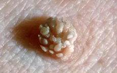 HPV感染：性生活并非唯一途径揭秘